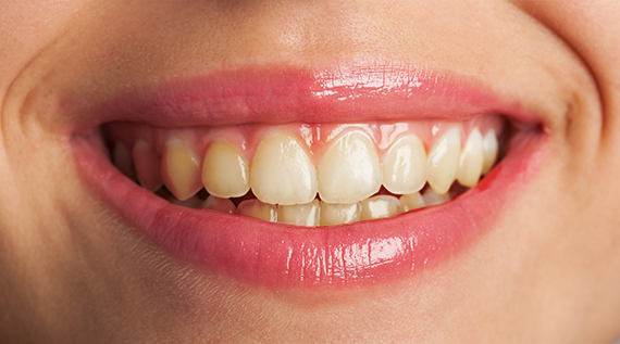 Smile before treatment