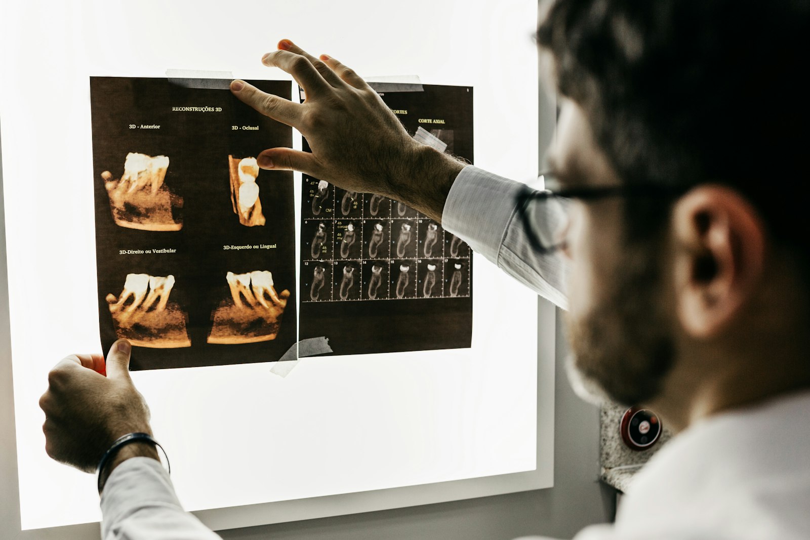 Dental Implants at Global Dental Group, Mission Viejo